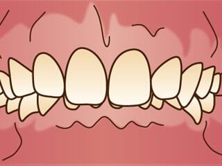 上下顎前突について