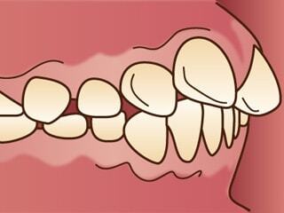 顎前突（じょうがくぜんとつ）について